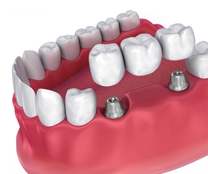 Dental Crowns and Bridges